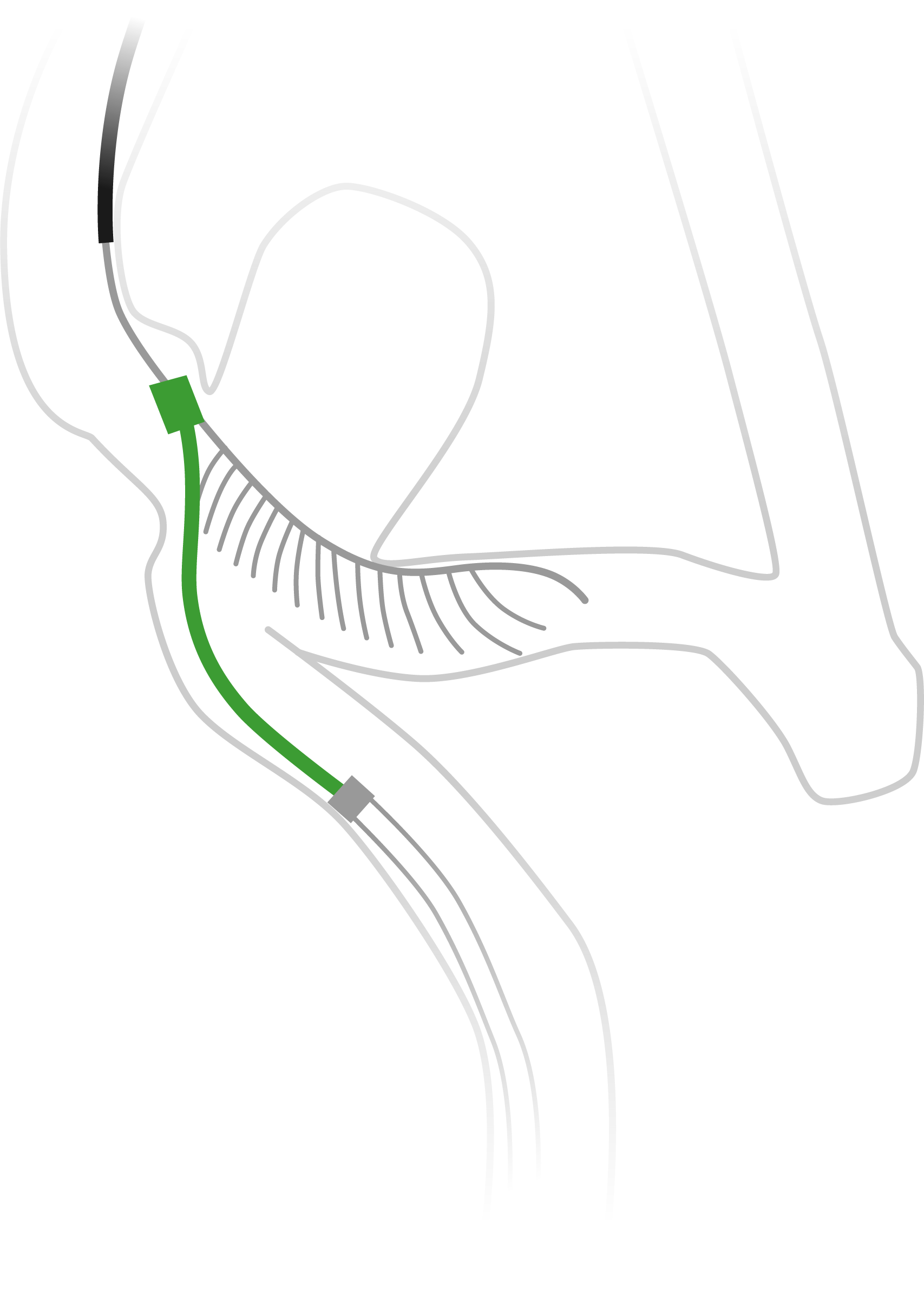 eCLIPs Medical Devices for Cerebral Aneurysm
